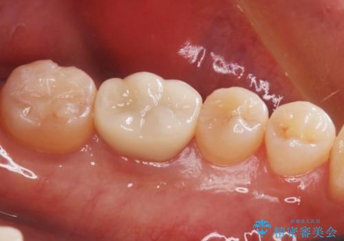【セラミックインレー】奥歯の詰め物とれたの症例 治療後