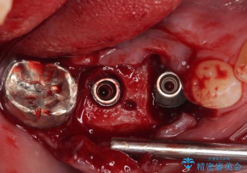 放置して膿で腫れ上がった奥歯　短期間でのインプラント治療の治療中
