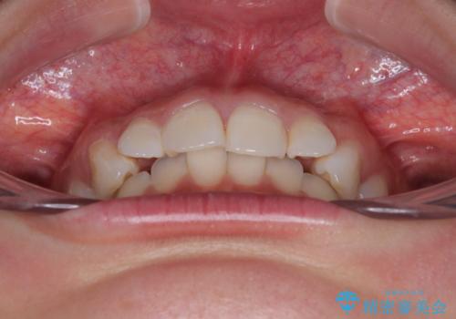 デコボコと咬み合わせを改善 インビザライン矯正治療の治療前