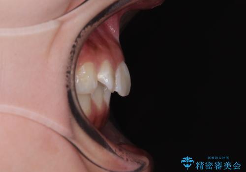 デコボコと咬み合わせを改善 インビザライン矯正治療の治療前