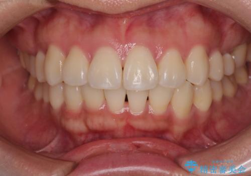 デコボコと正中のずれを改善した矯正治療の治療後