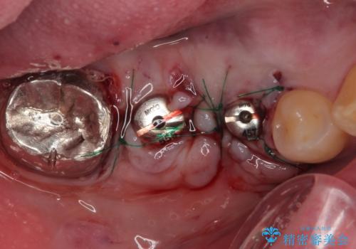 放置して膿で腫れ上がった奥歯 短期間でのインプラント治療の治療中