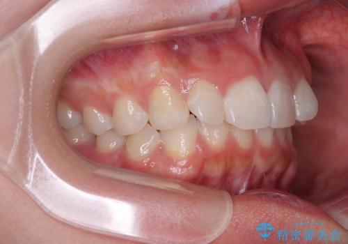 デコボコと咬み合わせを改善　インビザライン矯正治療の治療前