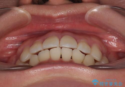 デコボコと正中のずれを改善した矯正治療の治療後