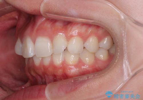 デコボコと咬み合わせを改善 インビザライン矯正治療の治療前