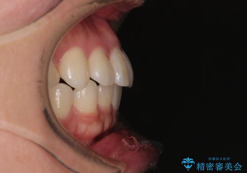 デコボコと正中のずれを改善した矯正治療の治療後