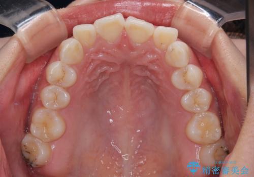 デコボコと咬み合わせを改善 インビザライン矯正治療の治療前