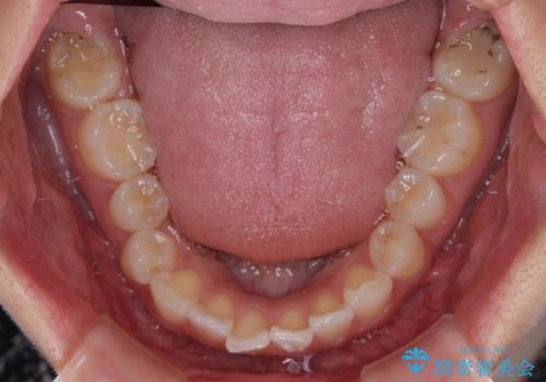 デコボコと咬み合わせを改善　インビザライン矯正治療の治療前