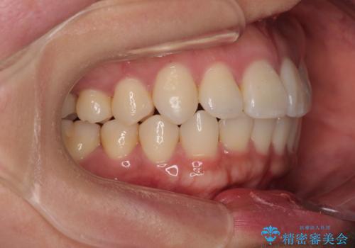 デコボコと正中のずれを改善した矯正治療の治療後