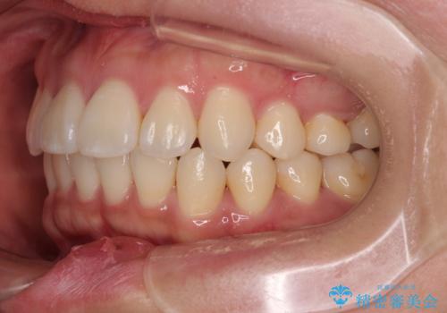 デコボコと正中のずれを改善した矯正治療の治療後