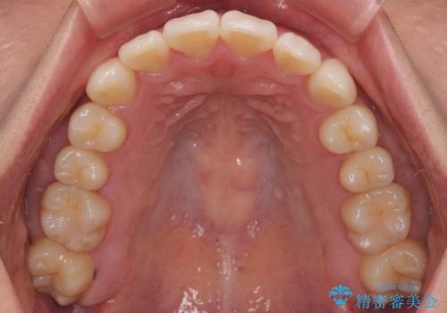 デコボコと正中のずれを改善した矯正治療の治療後