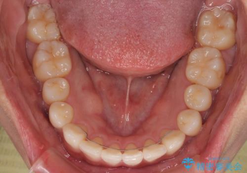 デコボコと正中のずれを改善した矯正治療の治療後
