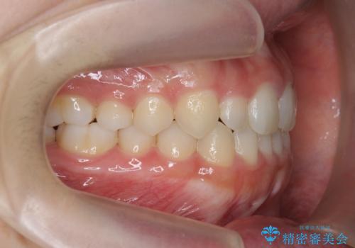 前歯のねじれ、がたつきをしっかり改善 部分ワイヤー+マウスピース矯正の治療後