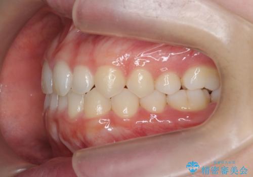 前歯のねじれ、がたつきをしっかり改善　部分ワイヤー+マウスピース矯正の治療後