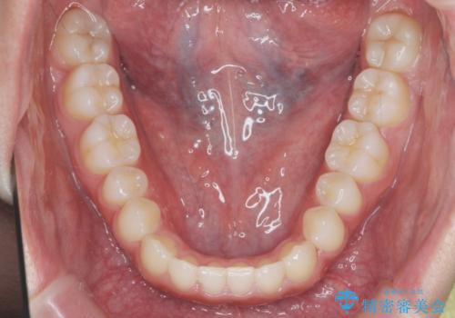 前歯のねじれ、がたつきをしっかり改善　部分ワイヤー+マウスピース矯正の治療後