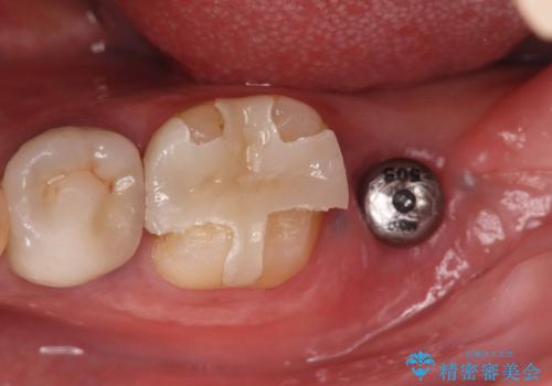 歯根嚢胞と瘻孔を伴う奥歯を抜歯即時インプラントで治療|一回の手術で改善!|インプラントの治療期間3か月の治療前