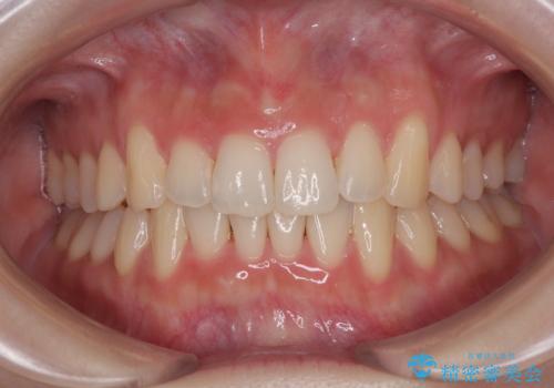前歯が隠れるほどのデコボコをインビザライン矯正できれいに整えるの症例 治療後