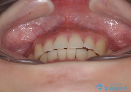 前歯が隠れるほどのデコボコをインビザライン矯正できれいに整えるの治療後