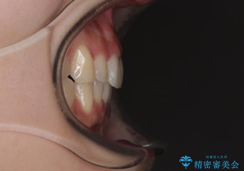 前歯が隠れるほどのデコボコをインビザライン矯正できれいに整えるの治療後