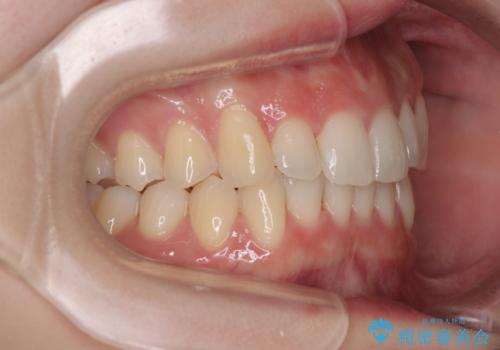 前歯が隠れるほどのデコボコをインビザライン矯正できれいに整えるの治療後