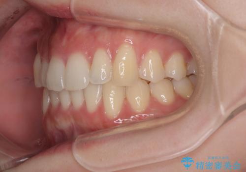 前歯が隠れるほどのデコボコをインビザライン矯正できれいに整えるの治療後