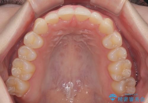 前歯が隠れるほどのデコボコをインビザライン矯正できれいに整えるの治療後