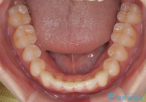 前歯が隠れるほどのデコボコをインビザライン矯正できれいに整えるの治療後