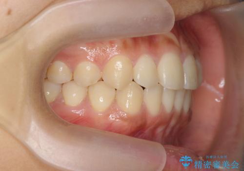 前歯のねじれ、すれ違いを改善　部分ワイヤー+マウスピース矯正の治療後