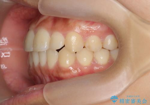 前歯のねじれ、すれ違いを改善　部分ワイヤー+マウスピース矯正の治療後