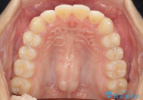 前歯のねじれ、すれ違いを改善　部分ワイヤー+マウスピース矯正の治療後