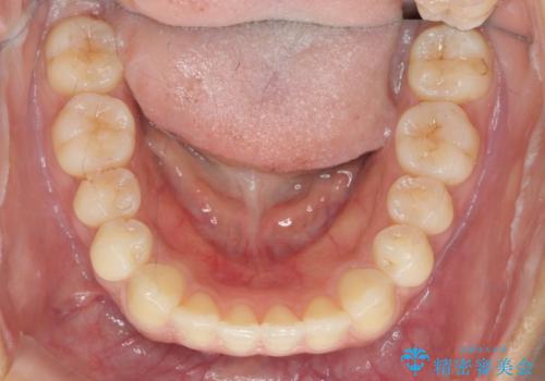 前歯のねじれ、すれ違いを改善　部分ワイヤー+マウスピース矯正の治療後