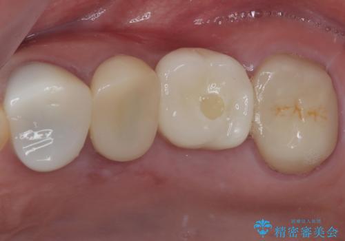 予後不良の奥歯　抜歯即時埋入インプラントによる補綴治療の症例 治療後