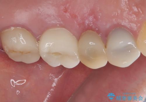 予後不良の奥歯 抜歯即時埋入インプラントによる補綴治療の治療後