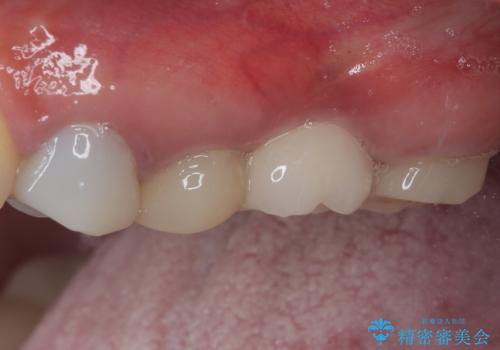 予後不良の奥歯　抜歯即時埋入インプラントによる補綴治療の治療後