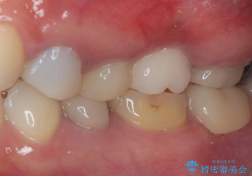 予後不良の奥歯　抜歯即時埋入インプラントによる補綴治療の治療後