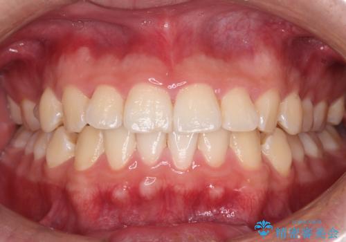 初めてのホワイトニングで1日で歯を白く!の治療前