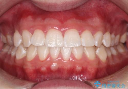 初めてのホワイトニングで1日で歯を白く!の治療後