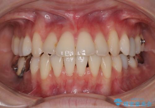 【モニター】前歯のデコボコをインビザラインで綺麗にの治療中