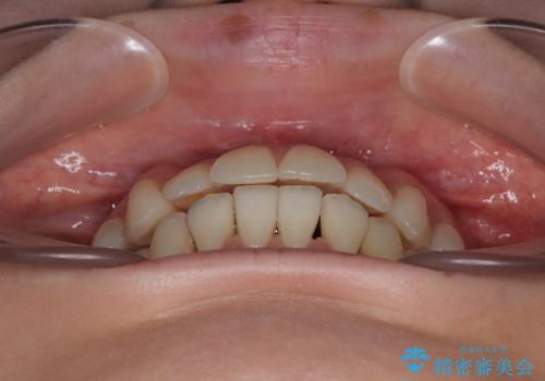 【モニター】前歯のデコボコをインビザラインで綺麗にの治療中