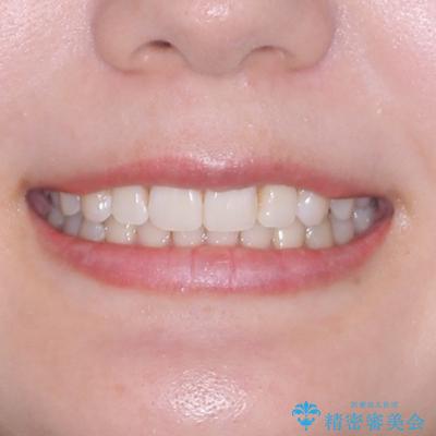 デコボコと咬み合わせを改善 インビザライン矯正治療の治療後(顔貌)