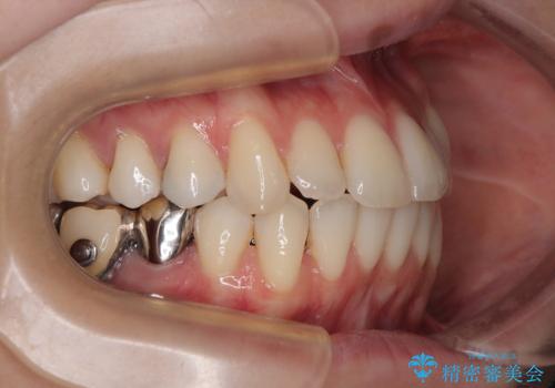 【モニター】前歯のデコボコをインビザラインで綺麗にの治療中