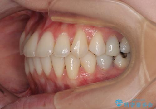 【モニター】前歯のデコボコをインビザラインで綺麗にの治療中