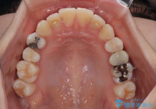 【モニター】前歯のデコボコをインビザラインで綺麗にの治療中