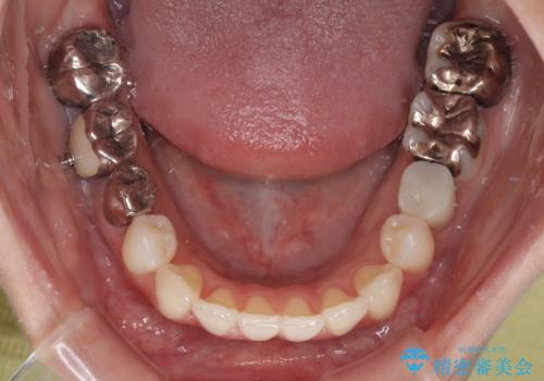 【モニター】前歯のデコボコをインビザラインで綺麗にの治療中