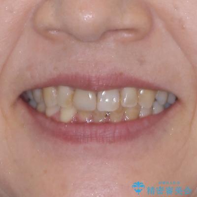 むし歯治療とインビザライン矯正治療 総合歯科治療で整った口腔内にの治療後(顔貌)