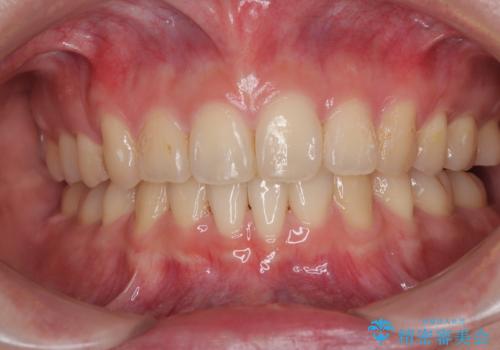 深い咬み合わせと飛び出した前歯　ワイヤー装置での抜歯矯正治療の治療後