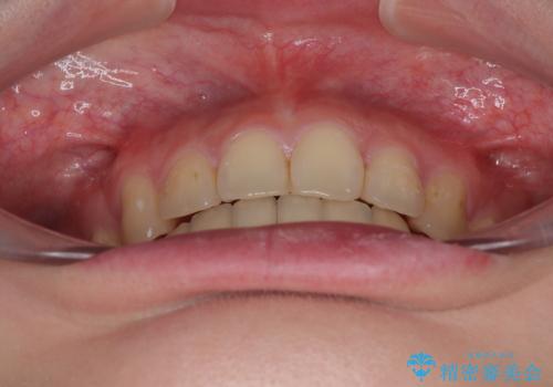 深い咬み合わせと飛び出した前歯 ワイヤー装置での抜歯矯正治療の治療後