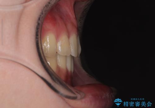 深い咬み合わせと飛び出した前歯 ワイヤー装置での抜歯矯正治療の治療後