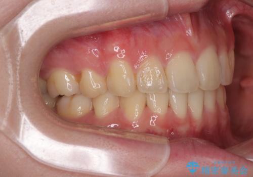 深い咬み合わせと飛び出した前歯　ワイヤー装置での抜歯矯正治療の治療後