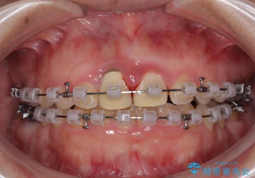 前歯のデコボコをワイヤー矯正で綺麗に 保険診療の前歯クラウンもセラミッククラウンで自然にの治療中